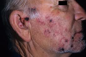 facial nerves shingles Anal masturbation tecnique